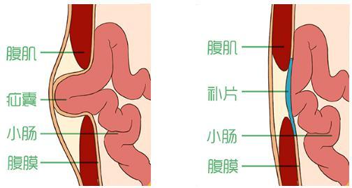 什么是单孔腹腔镜腹股沟疝修补术有何优势普外科王晓亮