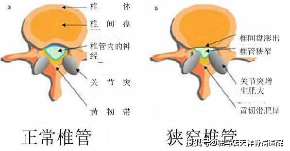 学生腰痛怎么办