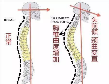 很多时候是胸椎曲度增加的结果,所以我们仅仅对颈椎进行康复训练是不