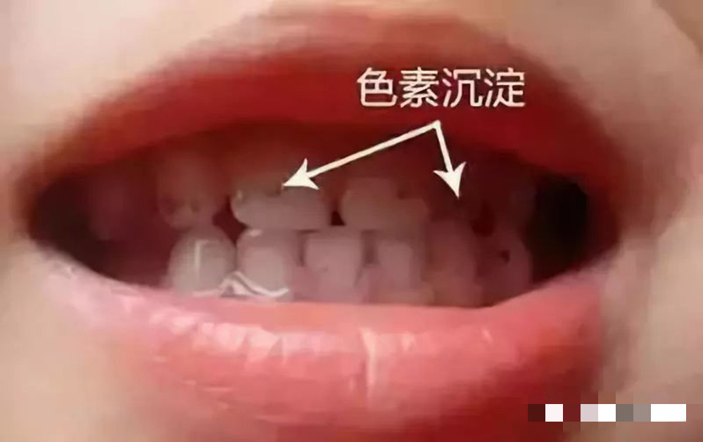 宝宝牙齿又黄又黑还被腐蚀宝妈不要慌看看是不是这些原因