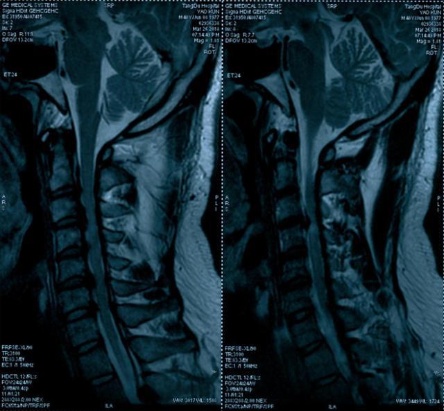 拍了x光片,为何又要拍ct,核磁?颈,腰椎病患者该拍哪一