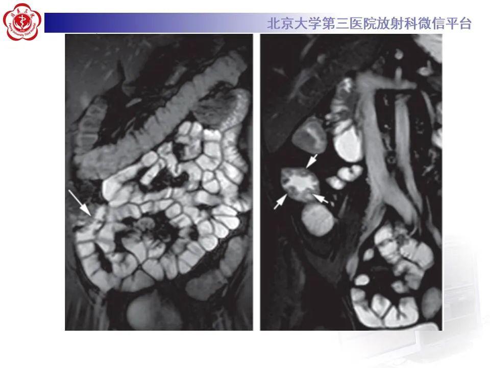 ct/mr小肠造影(cte/mre)检查要点