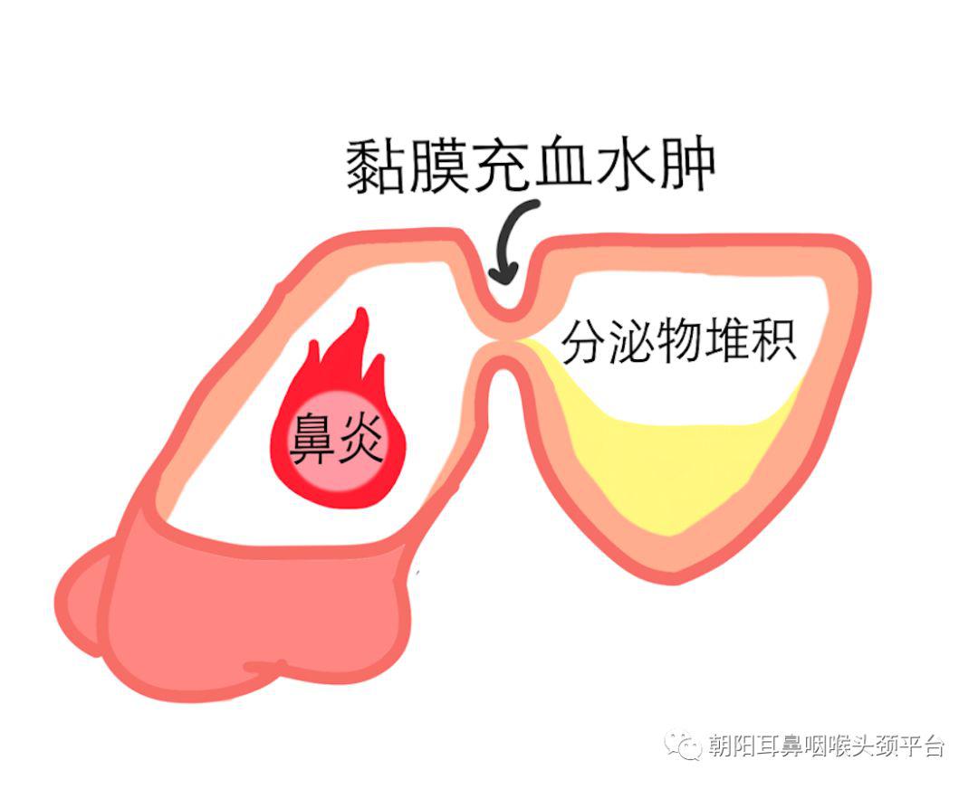 头痛系列急性鼻窦炎