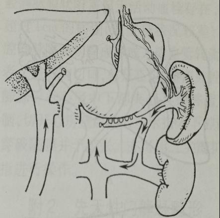 (warren手术)rex手术是将肠系膜上静脉与门静脉左主支之间进行血管