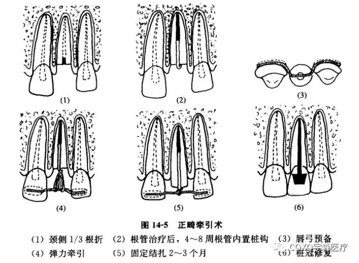 牙折与牙脱位