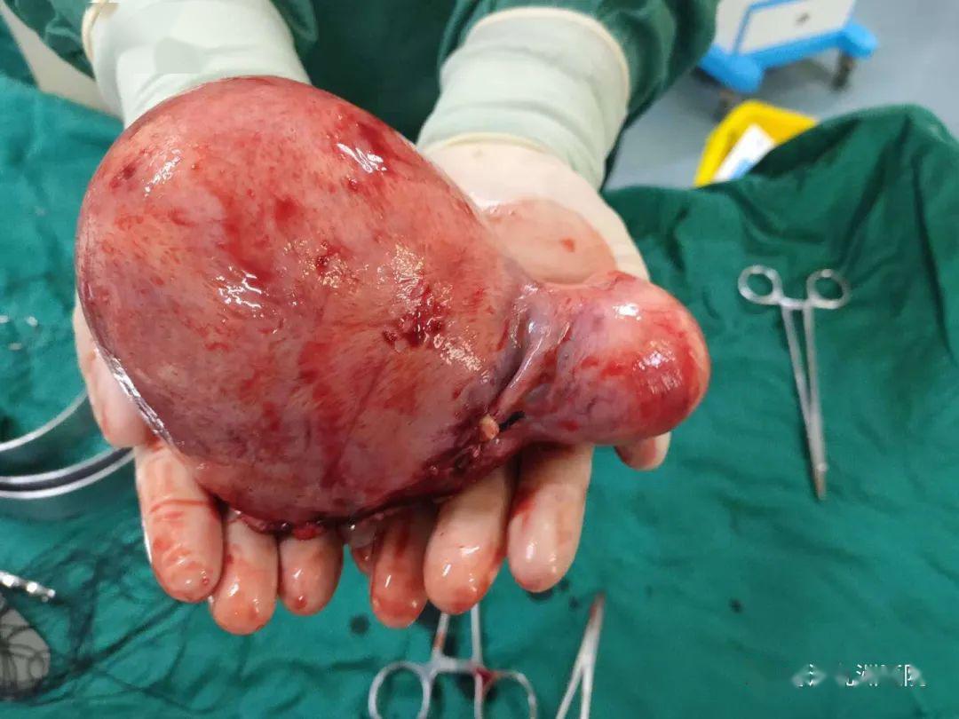 巨大子宫肌瘤切除术患者