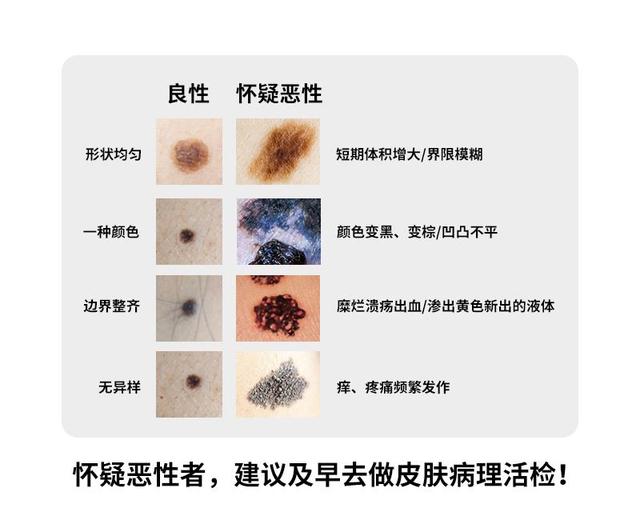 也和黑色素瘤的出现没有关系,它仅仅是皮肤的正常表现而已