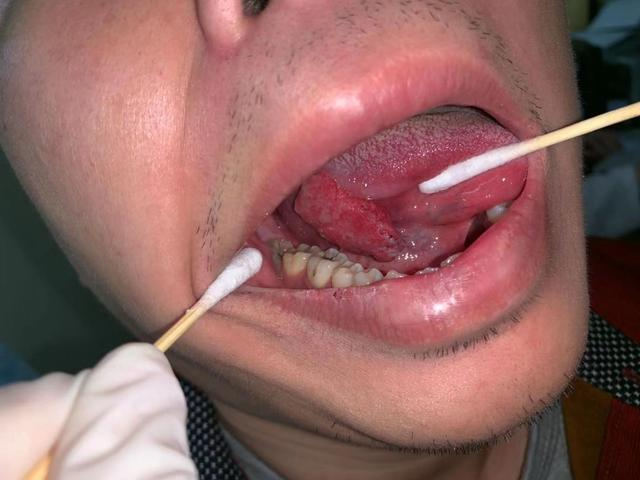 发现长在舌头下的肿物已经很大了,且病例结果证实是鳞状细胞癌