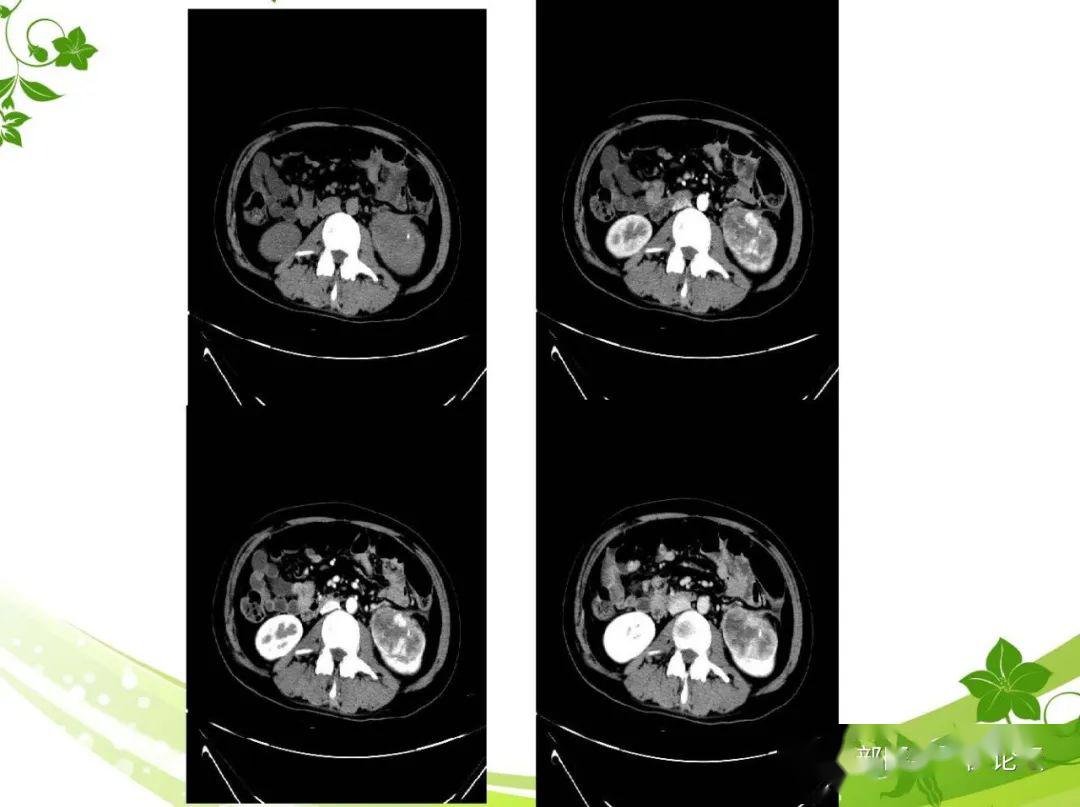 肾脏丨左肾透明细胞癌