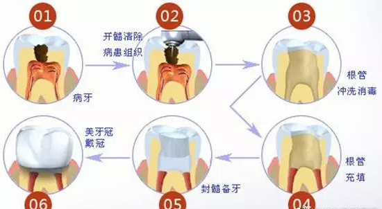 在某些情况下,做完根管治疗还需要戴上牙冠来保护牙齿.