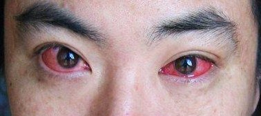 我们平时所说的"红眼病"是人们对具有传染性和流行性的眼睛发红,结膜