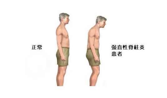 正常人和得了强直性脊柱炎的人的示意图