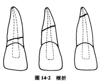 牙折与牙脱位