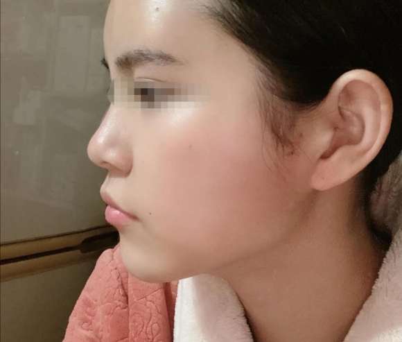 皮肤修复过程中可能的副作用 6a9a211fed214df9922a46aa3107d24c.jpeg