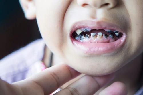2岁孩子满嘴“小黑牙”，不是因为吃糖，是父母的无知在坑娃