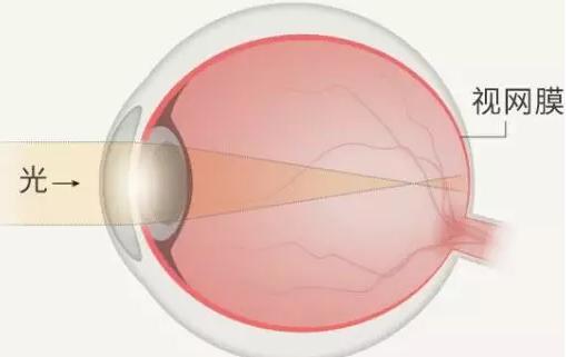 眼角膜在眼球表面吗 979640dba47a4eb98c5cf99dede9ebc0.jpeg