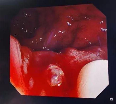 病例分享|硬化剂治疗新冠肺炎合并内痔失血性休克一例