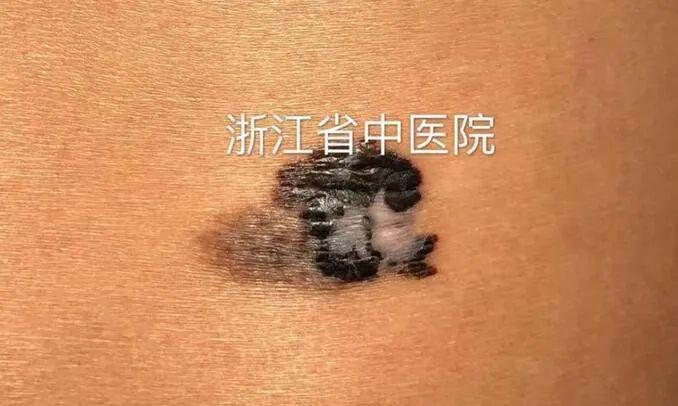 恶性黑色素瘤是由交界痣或混合痣的痣发展而来