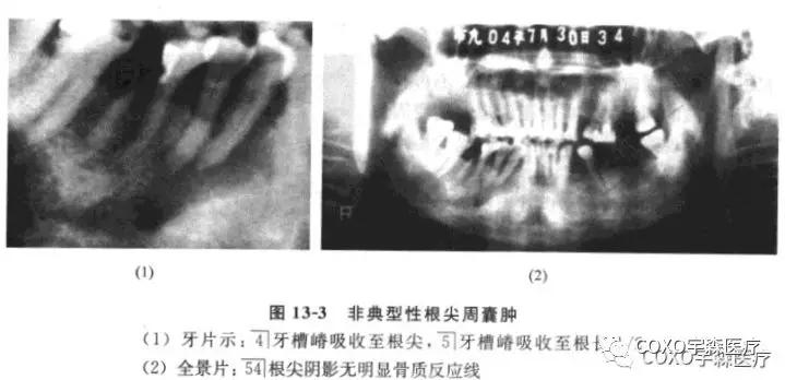本病例的临床诊断为根尖周囊肿,似无太大疑问,但x线表现则十分不典型