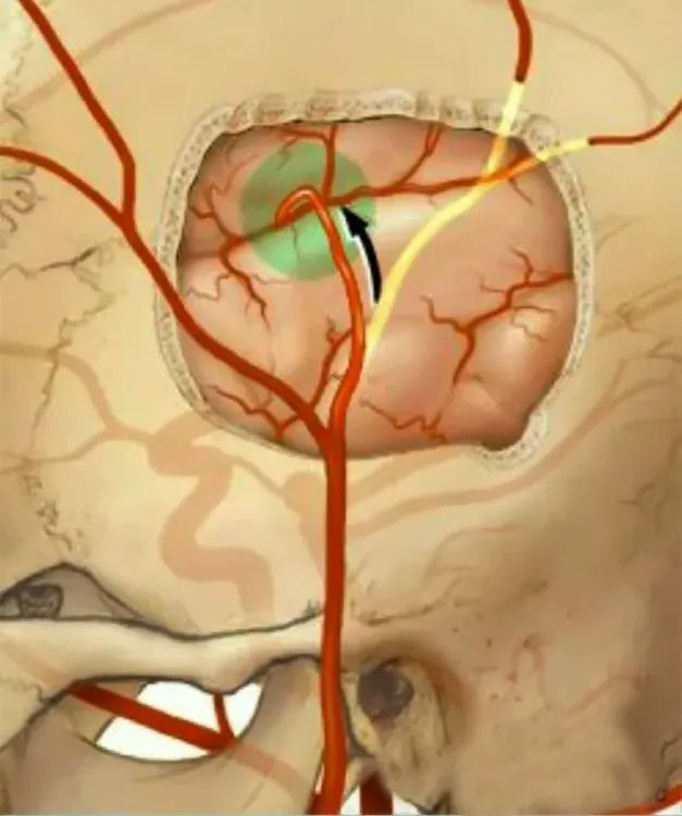 蓝十字脑科五旬男子大脑中动脉闭塞张琪博士团队成功为其行颅内外血管