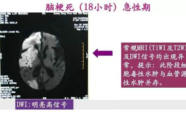 解剖&影像 超全面的脑梗死影像诊断，值得收藏！