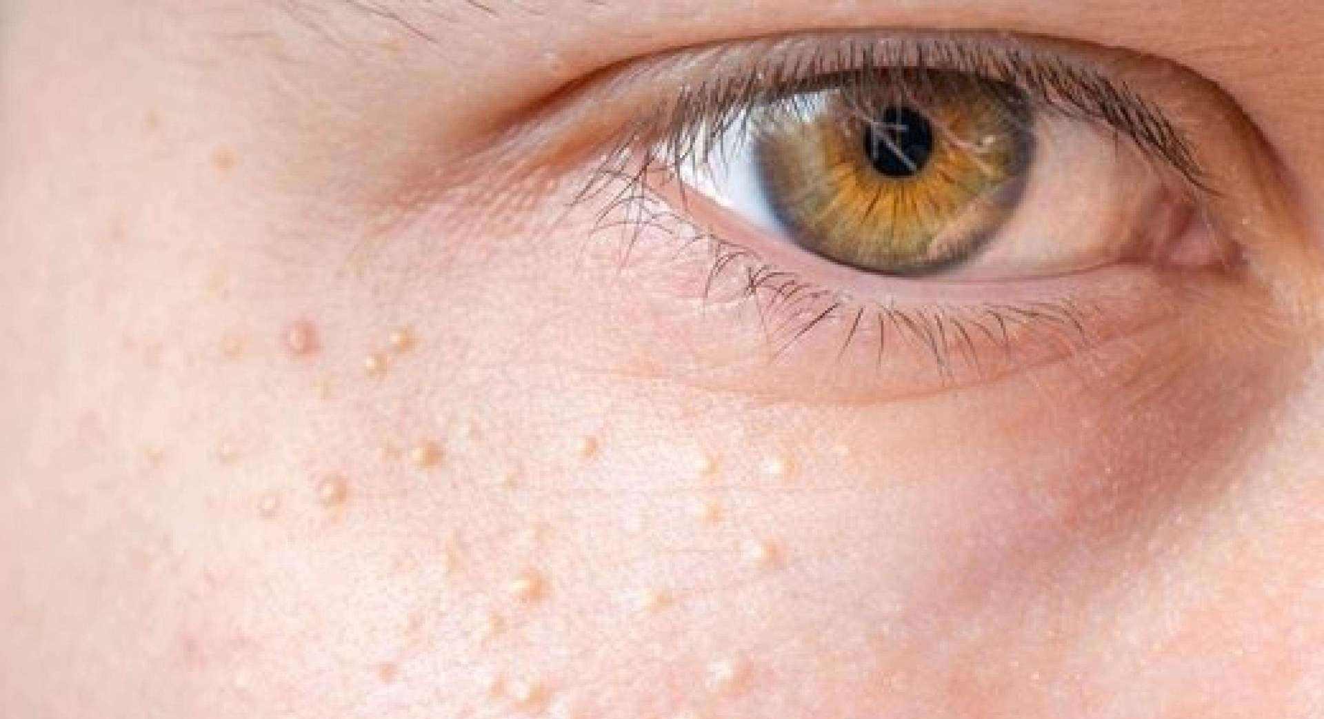 长满脂肪粒 难道是因为我胖