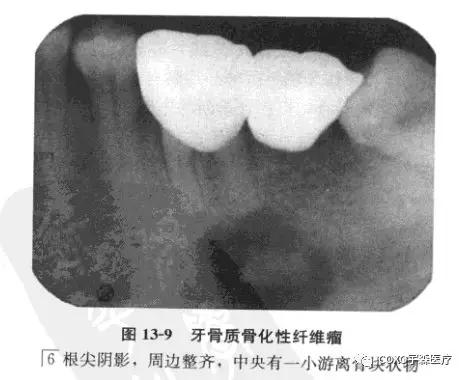 分析与评述牙骨质骨化性纤维瘤(cemento-ossifying fibroma),病理上