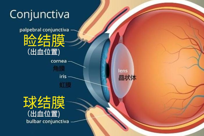 眼睛突然出血怎么办