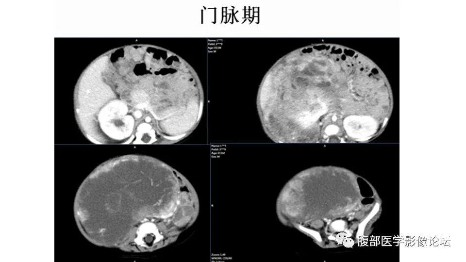 肾脏丨透明细胞肉瘤