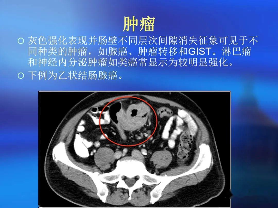 肠道壁增厚ct表现