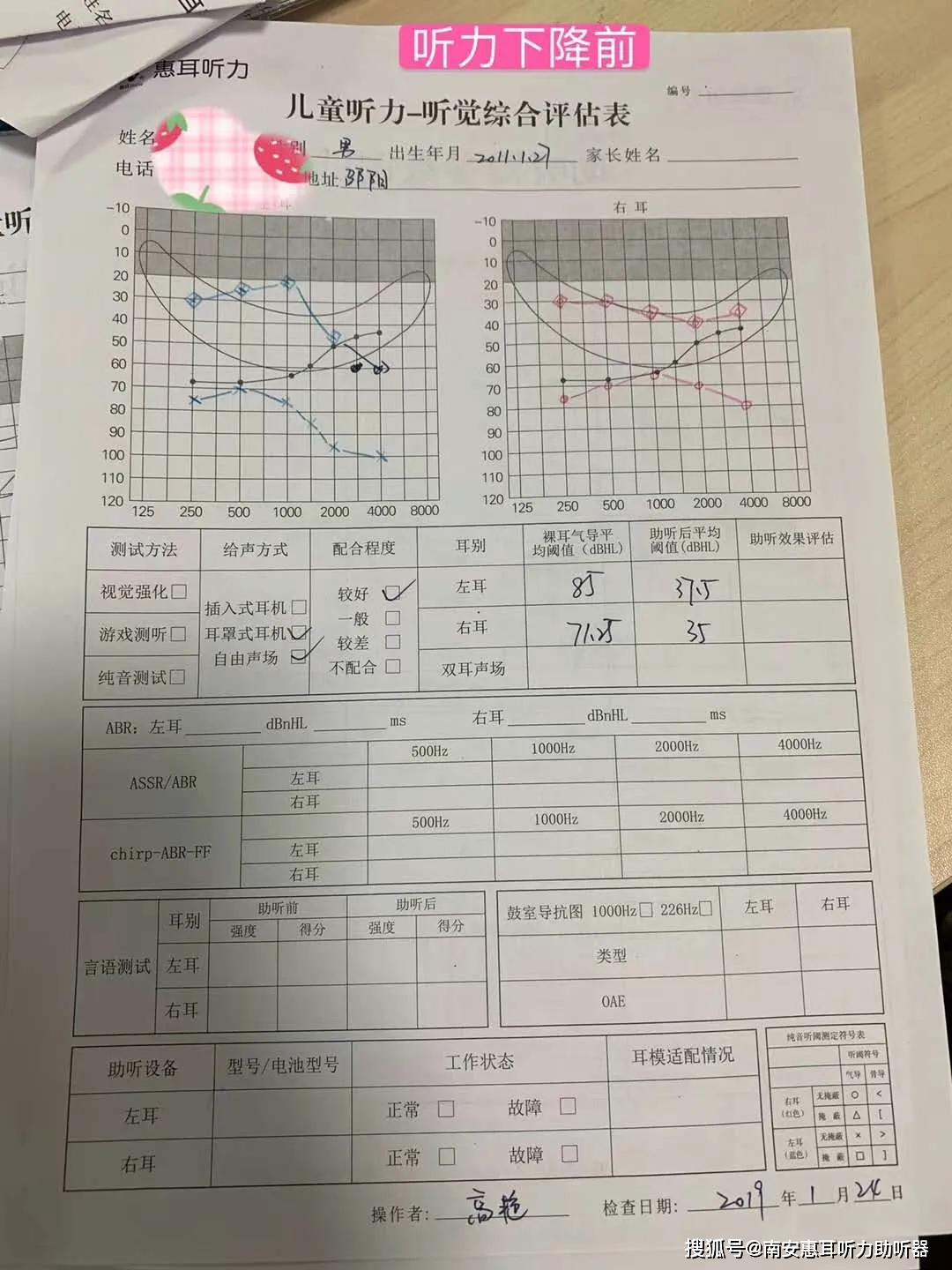 经过20天的中西医结合治疗 孩子双耳听力均已恢复,甚至较听力下降前