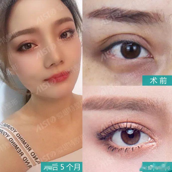 怎样可以让眼皮变薄一点 d2eb92ff12da456cbc9cbb3642efaa25.jpeg