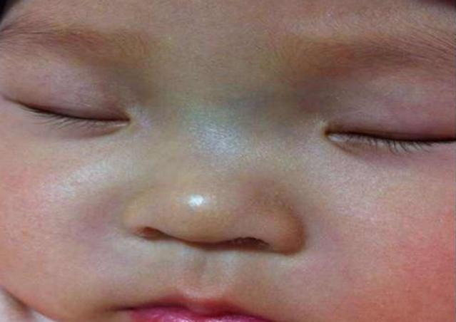 「孩子」老人说：宝宝鼻梁有“青筋”是体质弱脾气大？科学的解释你要知道