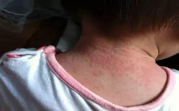 「宝宝」帮宝宝远离痱子！这些不外传的小绝招