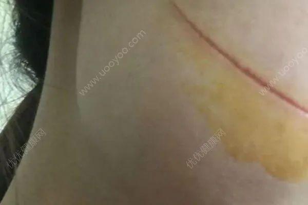 「风筝」惨痛！孩子放风筝,夫妻一个动作导致双双截掉四肢......
