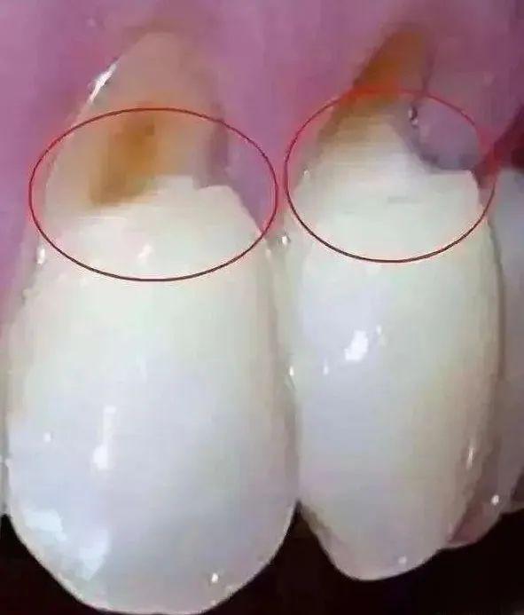 牙龈萎缩怎么办?
