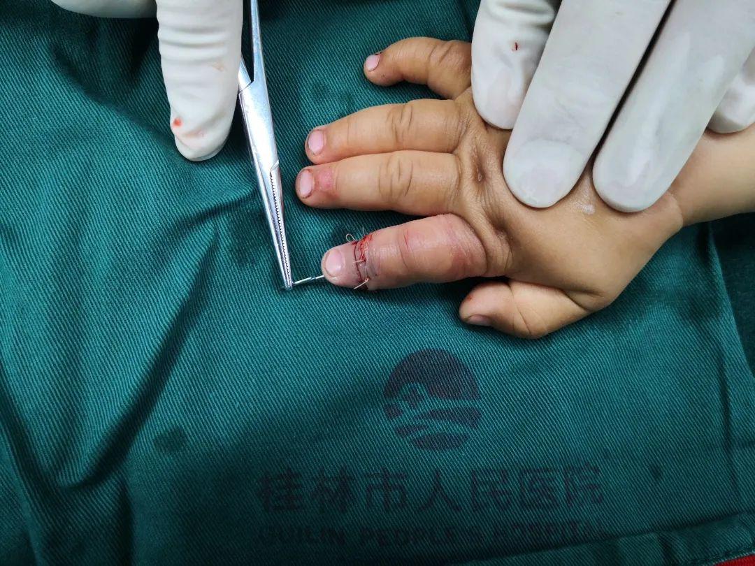 揪心桂林一岁孩子惨遭断指罪魁祸首竟是这东西