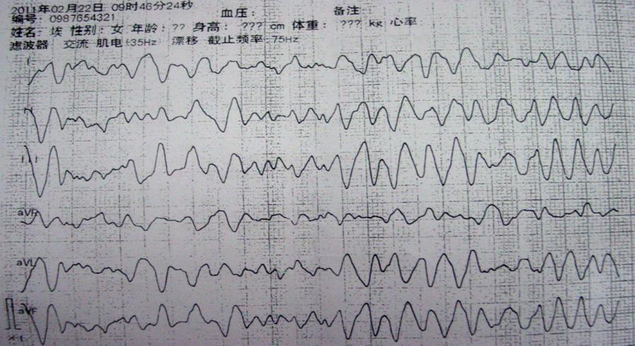 临床必备:猝死预警心电图分析