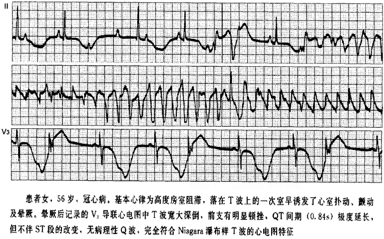 临床必备:猝死预警心电图分析