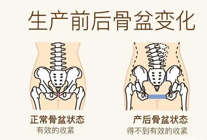 生娃后 肚子松垮,漏尿,屁股大 需要做产后修复吗