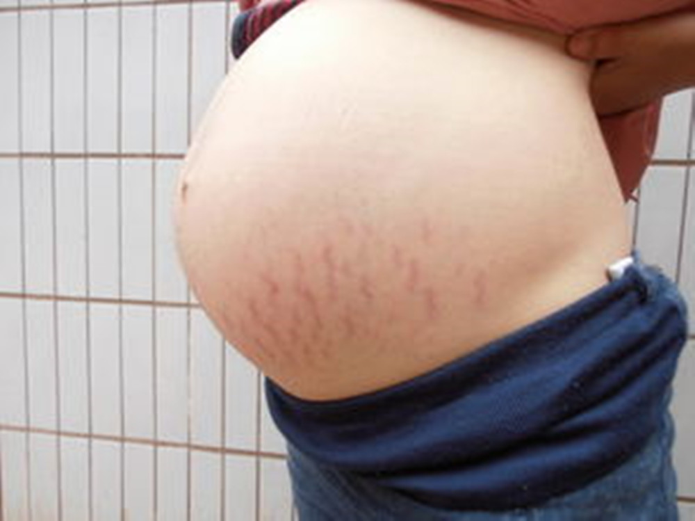 孕晚期是胎宝宝“猛长期”，也是妊娠纹高发期，宝妈要学会预防