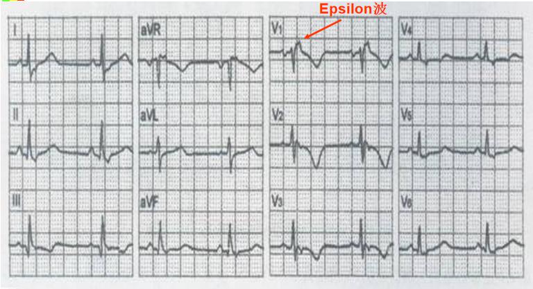 临床必备猝死预警心电图分析