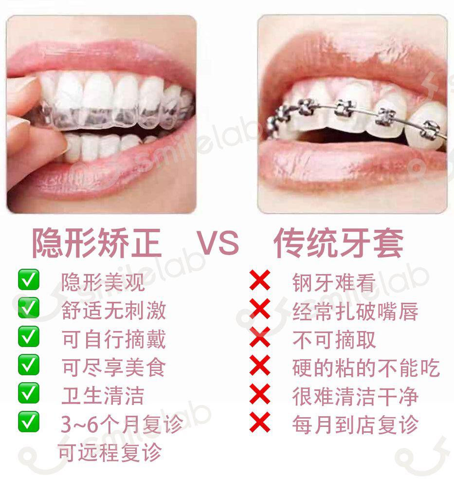 什么是隐形牙齿矫正 af2eb9740a8f4eddbbf3cd87ea5f8dda.jpeg