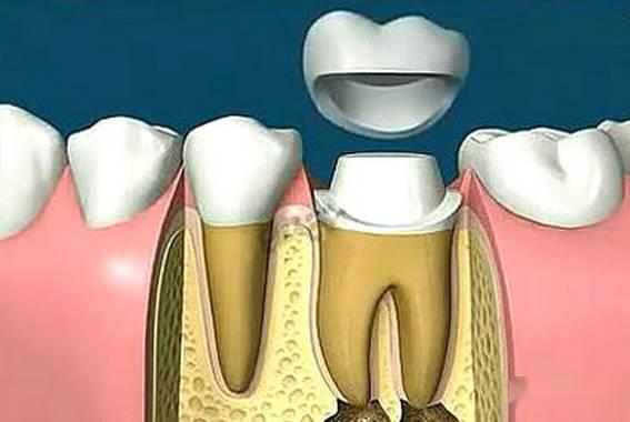 根管治疗后牙齿已经不疼了,为什么还要戴牙冠呢?