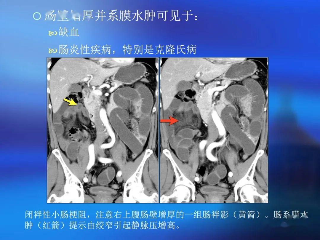 肠道壁增厚ct表现