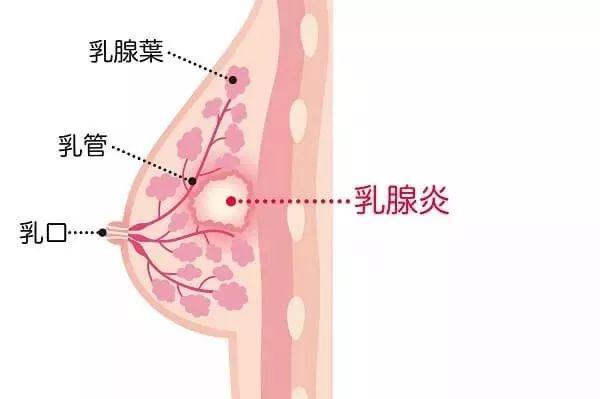 乳房硬得像石头,碰一下要亲命!分分钟让人想断奶的乳腺炎,该怎么办?