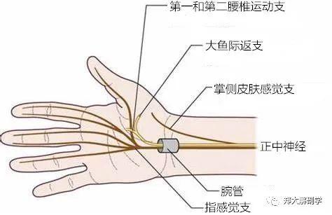 神经出腕管以后其鱼际肌支所受到软组织的卡压,外科手术松解痛苦大,术