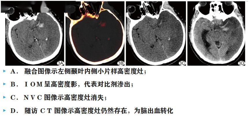 另外一例丘脑出血