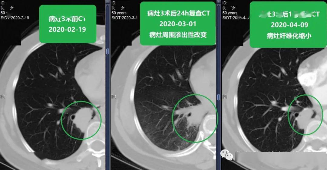 苏大附二院靳勇医生团队病例分享第53期——肺转移癌的介入消融治疗