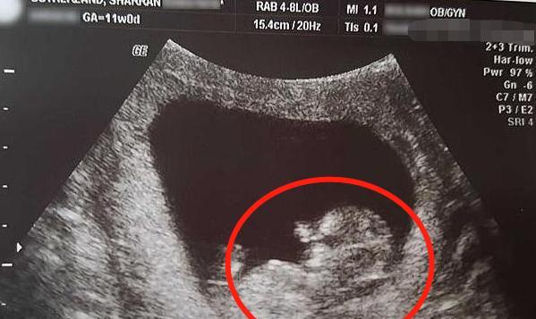 原创女子怀孕14周流产,胎儿原图曝光!长度仅10厘米但手脚已成型